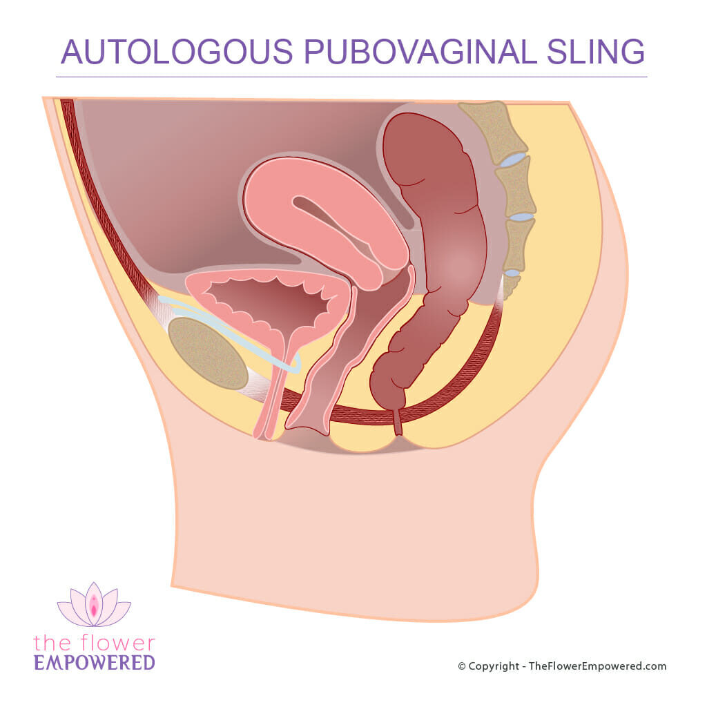 Incontinence Surgery - Autologous Pubovaginal Sling - biological graft
