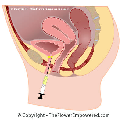 Stress Incontinence treatment - urethral Bulking agents