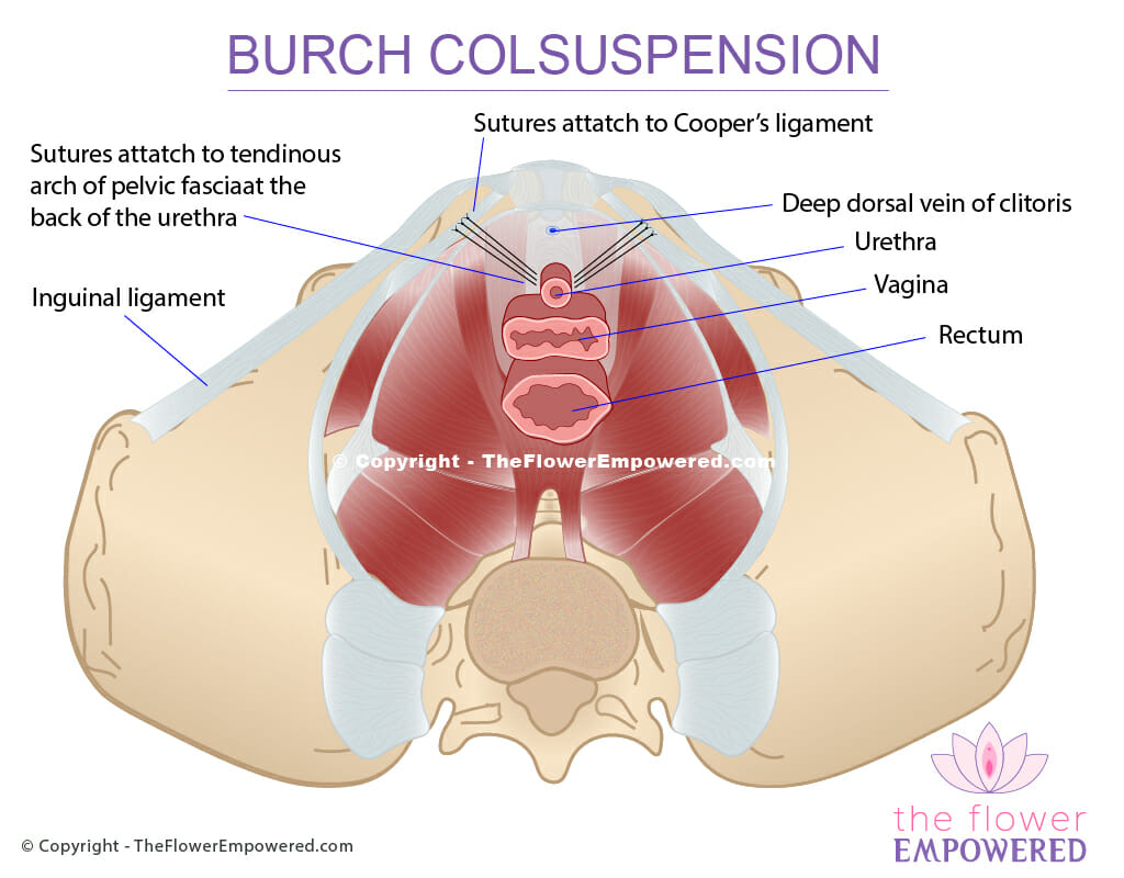 Stress incontinence treatment - Burch Colposuspension