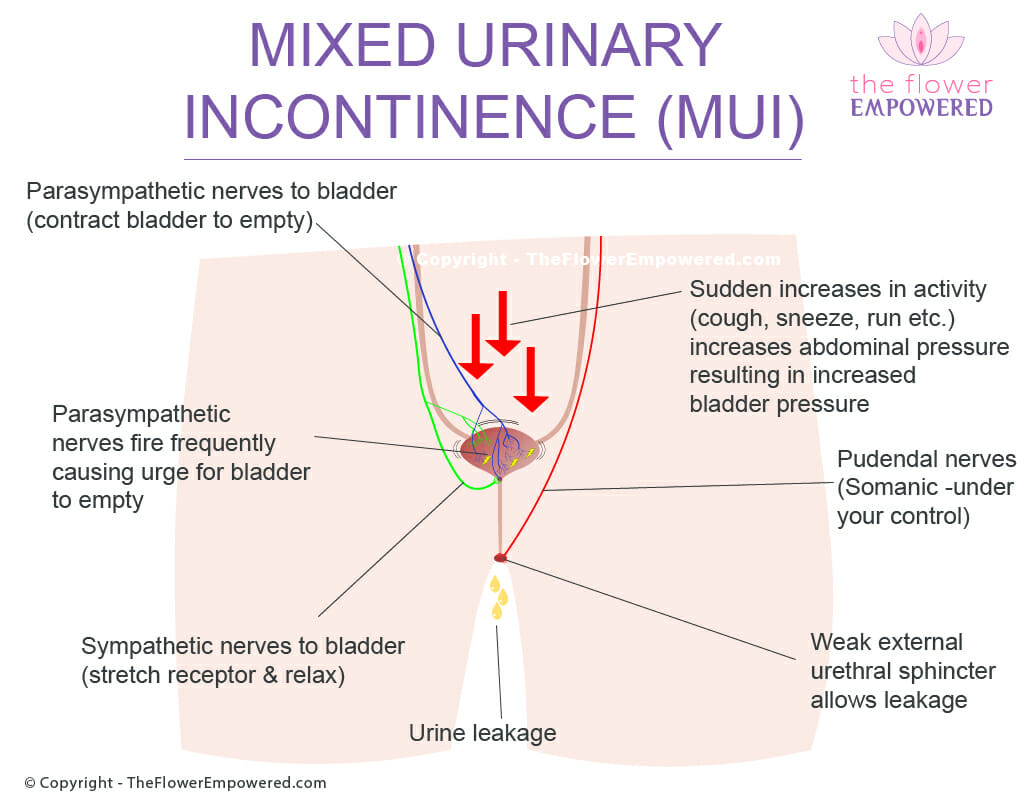 Mixed Urinary Incontinence