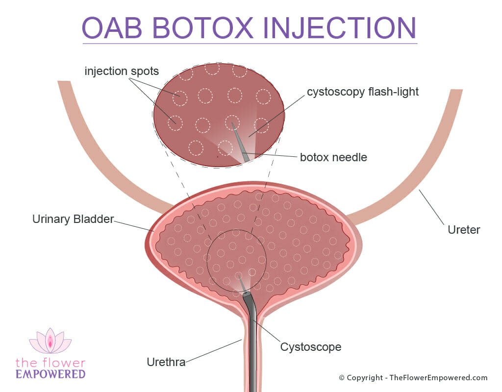 Bladder Botox for Urgency