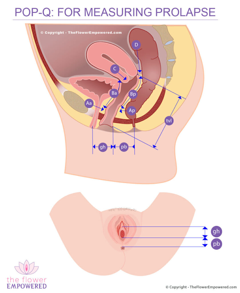Pelvic organ prolapse POP-Q-Measuring system