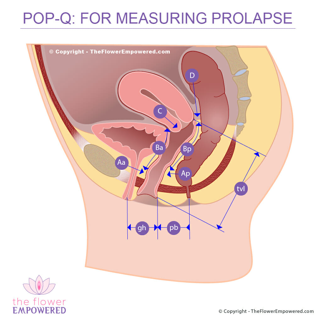 Классификация пролапса тазовых органов Pop-q