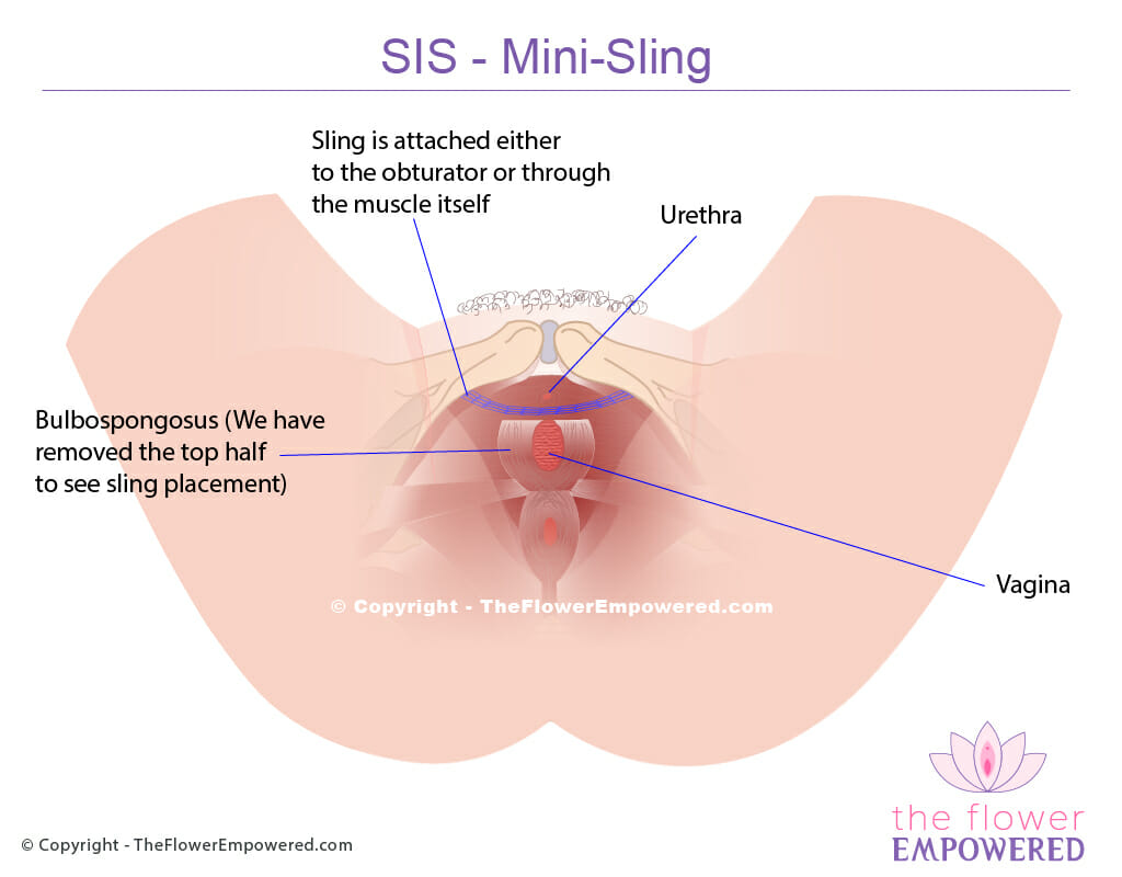 Stress incontinence treatment - SIS