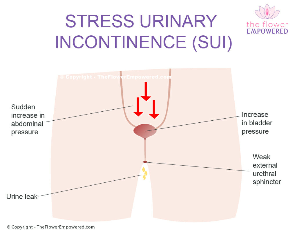 Stress Urinary Incontinence