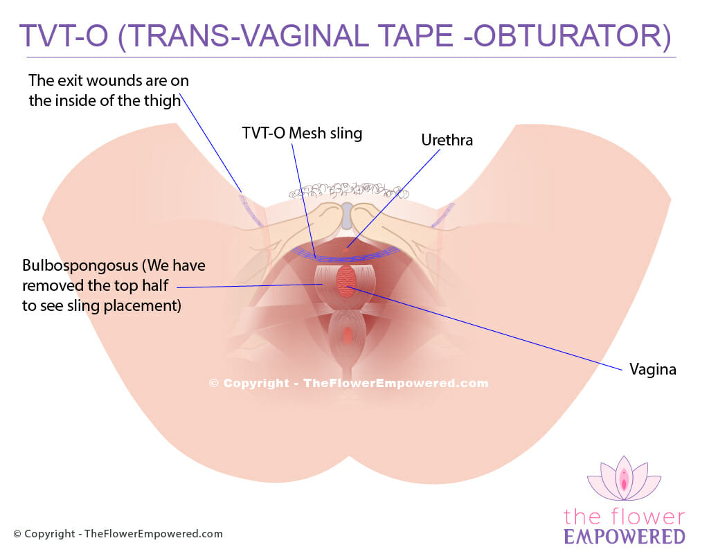 Stress incontinence treatment - TVT-O Mesh Sling