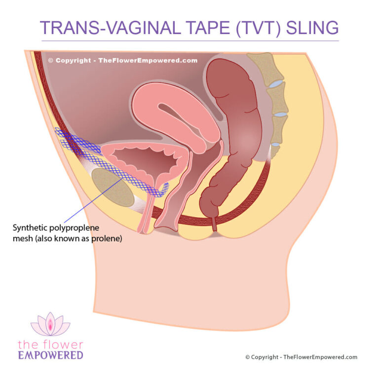Surgical Treatments for Urinary Incontinence