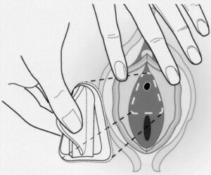 Urethral blocking devices