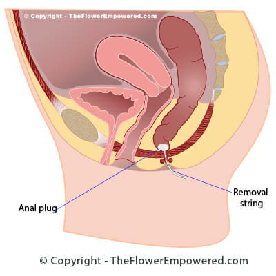 Anal Incontinence Plug