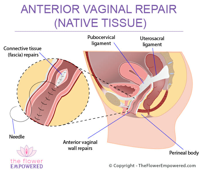Anterior Vagina Repair (Native Tissue) biological graft