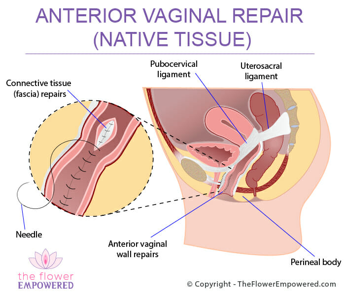 Assessing and treating sexual function after vaginal surgery