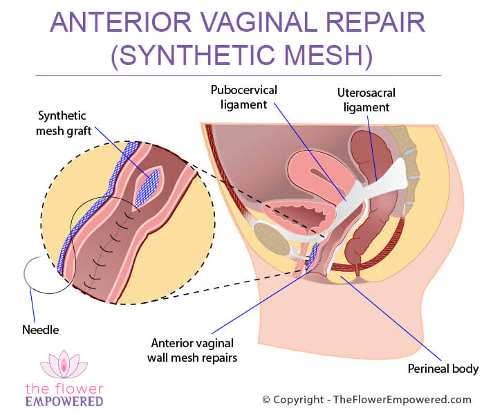 Anterior Vaginal Repair (Synthetic Mesh) Pelvic Mesh