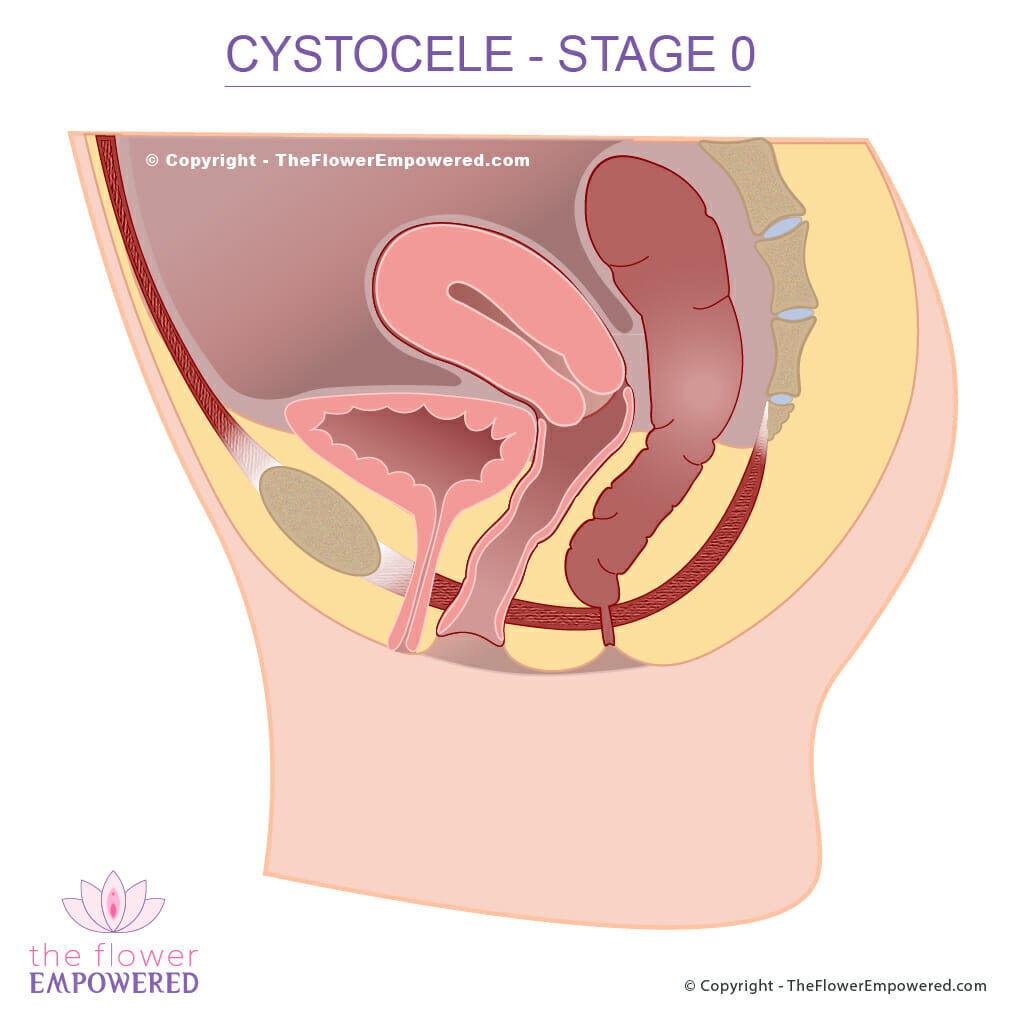 Cystocele Stage 0 © Copyright - TheFlowerEmpowered.com