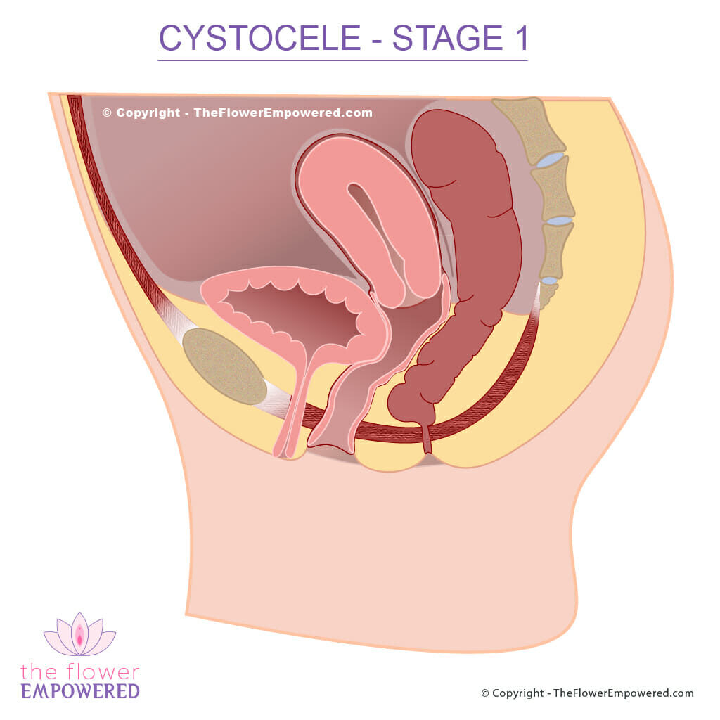 Cystocele pelvic organ prolapse Stage 1