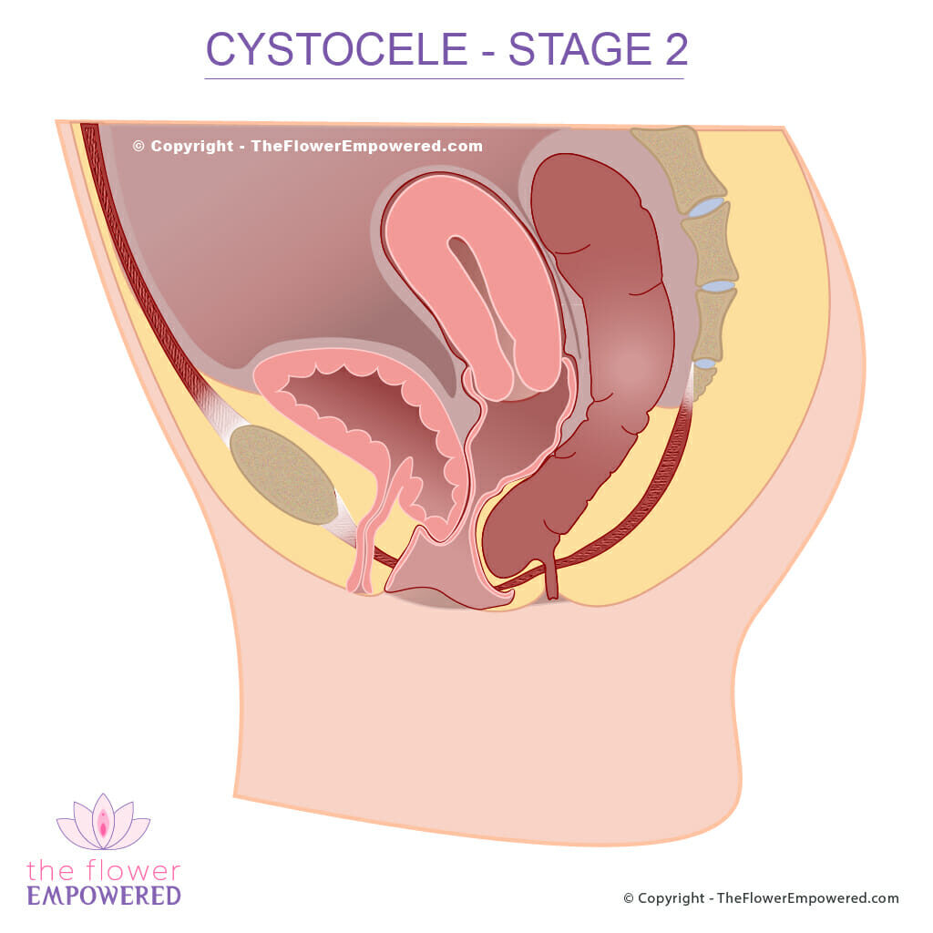 Cystocele pelvic organ prolapse Stage 2