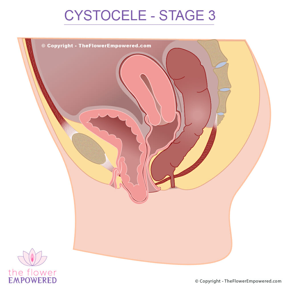 Cystocele (prolapsed bladder) - Pelvic organ prolapse - stage 0 to 4