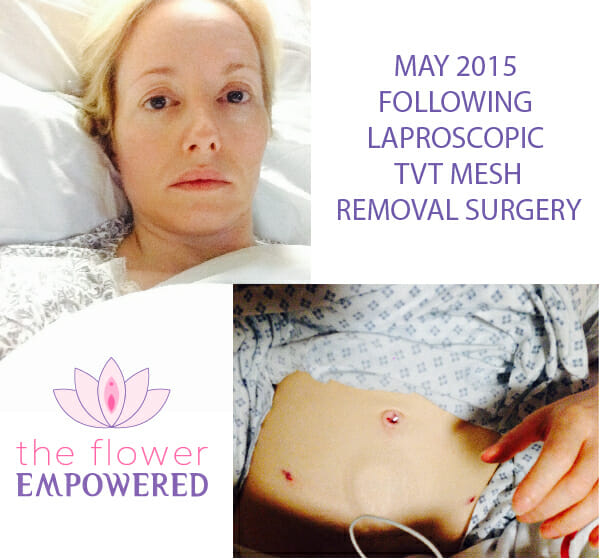 Denise following mesh removal May 2015