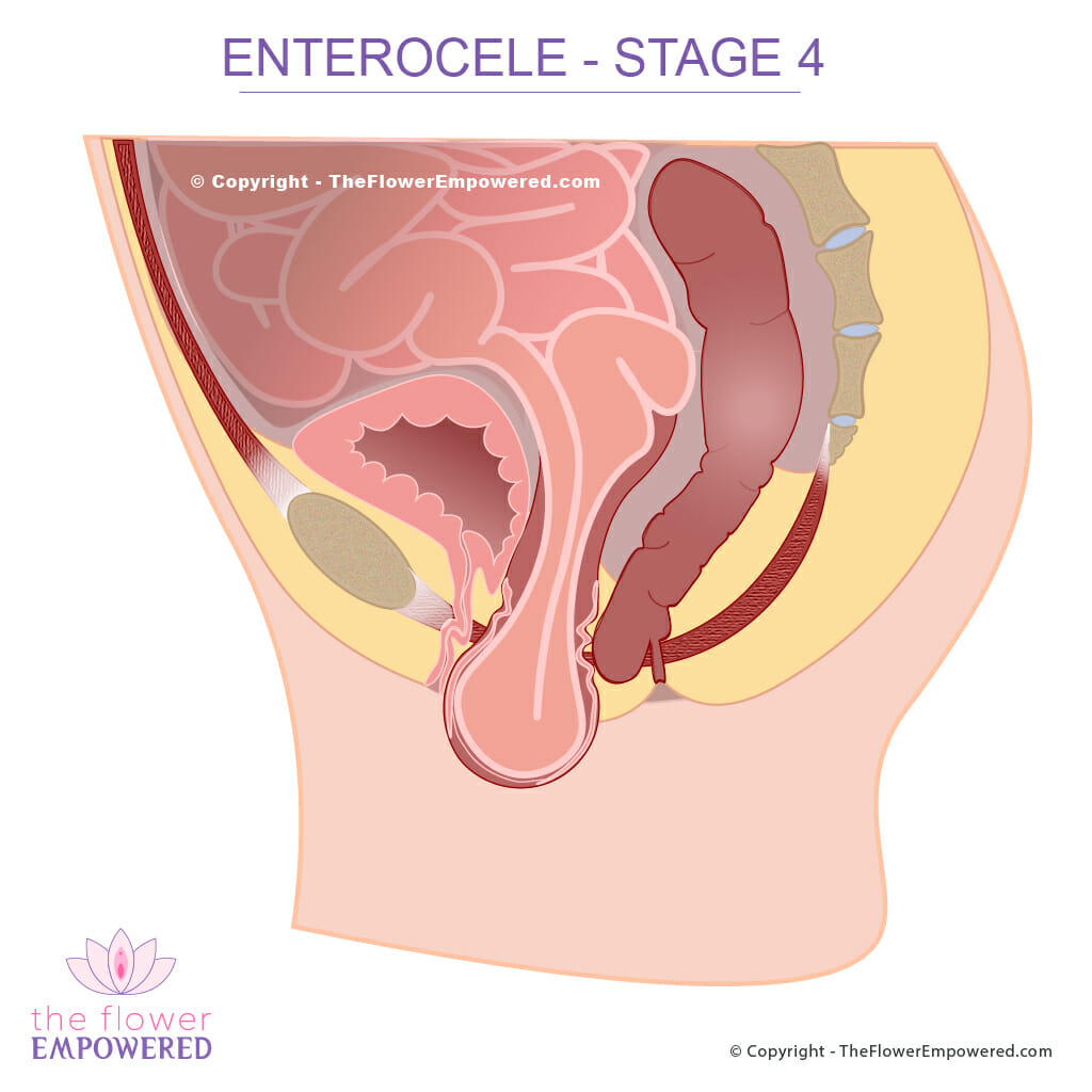 Enterocele Pelvic Organ Prolapse - stage 4