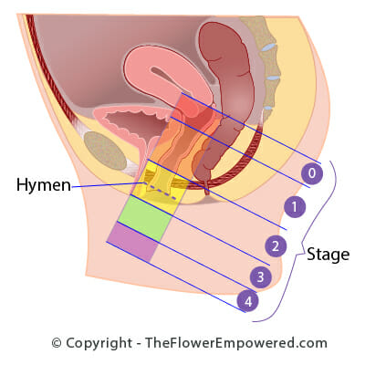 Pelvic Organ Prolapse Staging (Baden Walker)