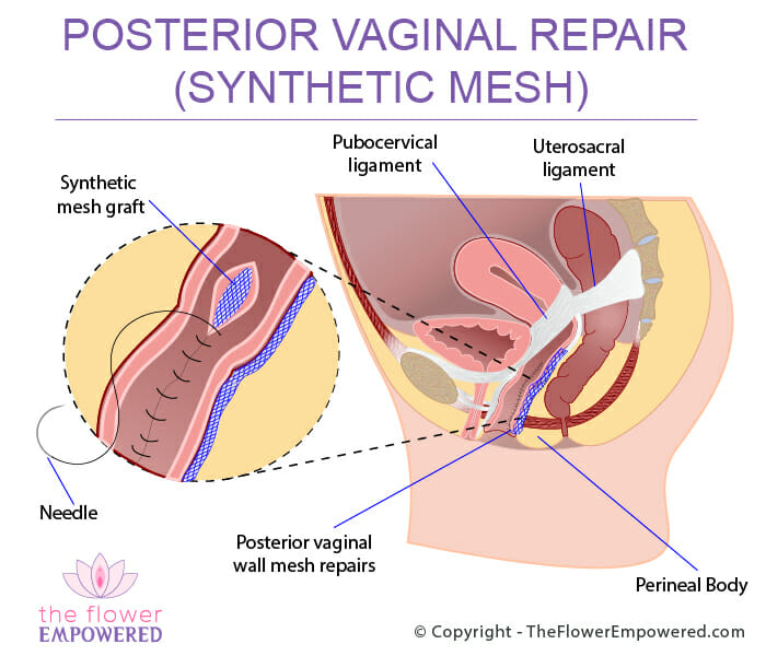 Posterior Vagina Repair (Synthetic Mesh) © Copyright - TheFlowerEmpowered.com