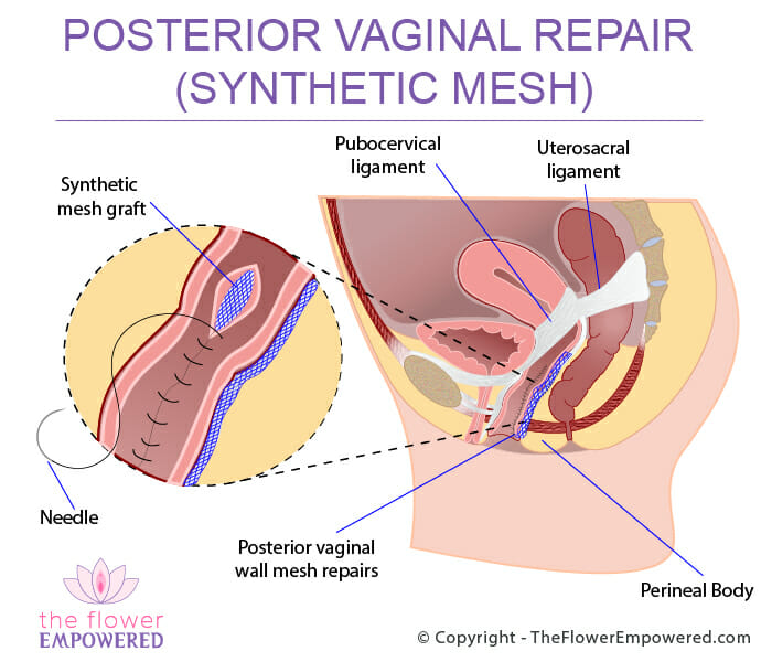 Vaginal Mesh Explained