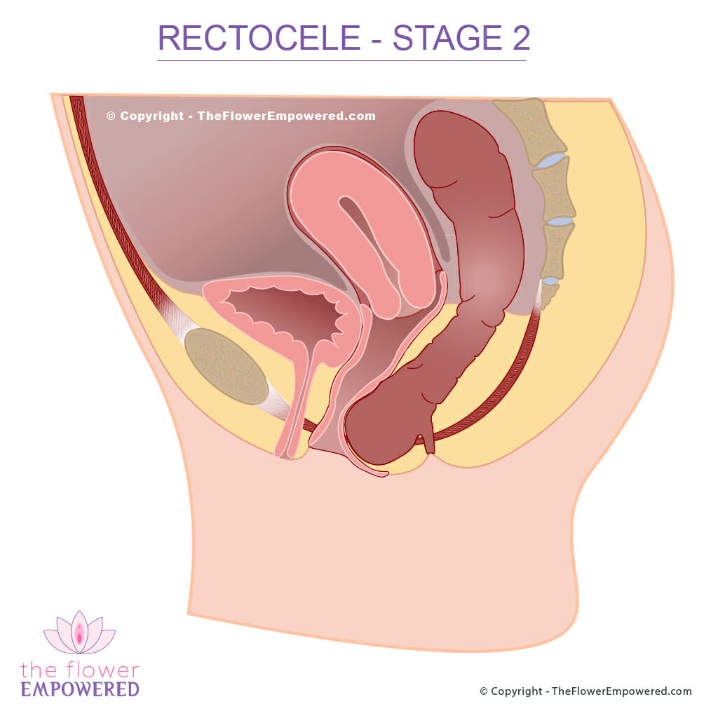 Rectocele Prolapsed Rectum Pelvic Organ Prolapse