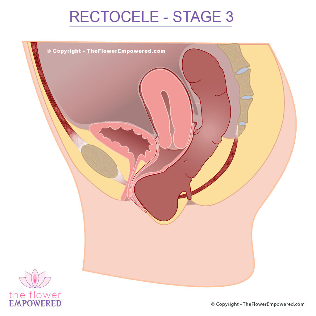 Rectocele pelvic organ prolapse stage 3