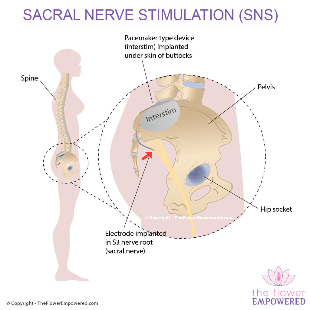 Sacral Nerve Stimulation