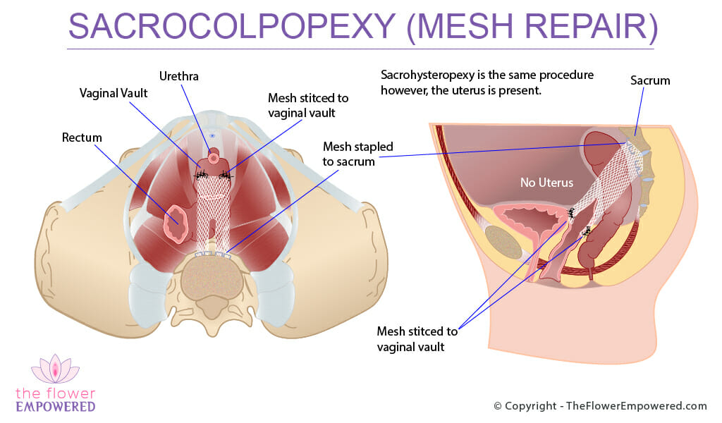 Sacrocolpopexy (no Uterus) - pelvic mesh