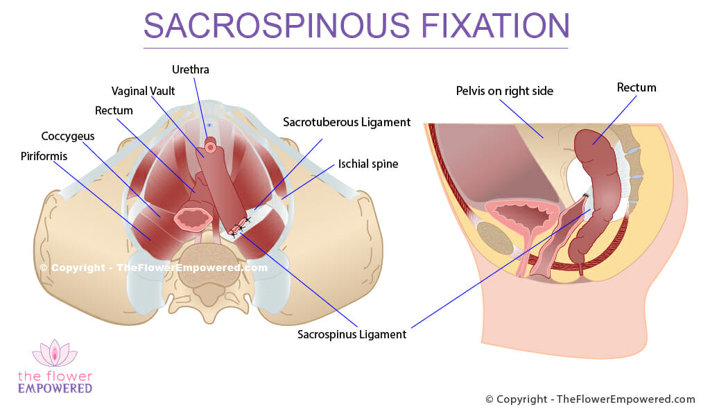 Sacrospinous Fixation