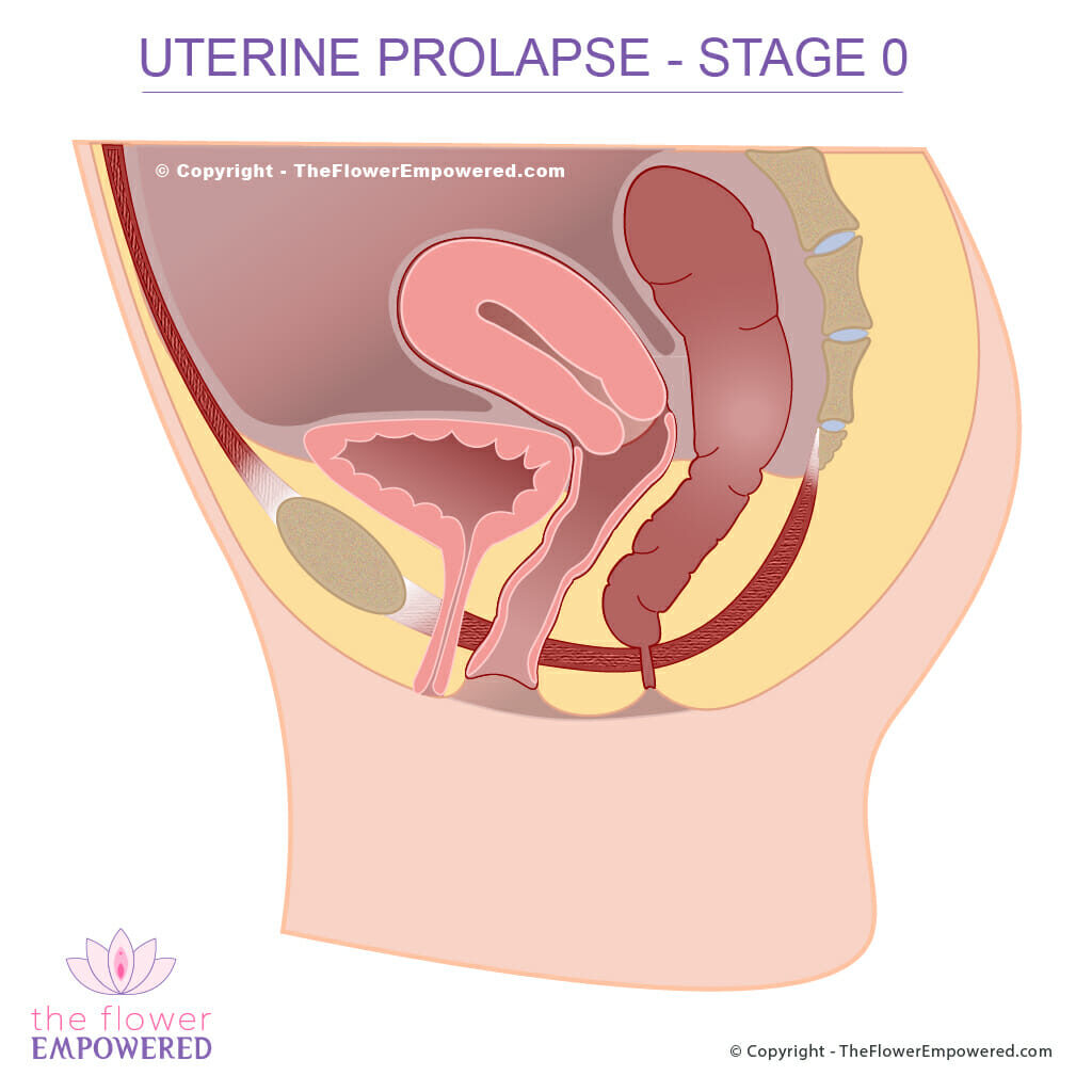Uterine Pelvic Organ Prolapse stage 0