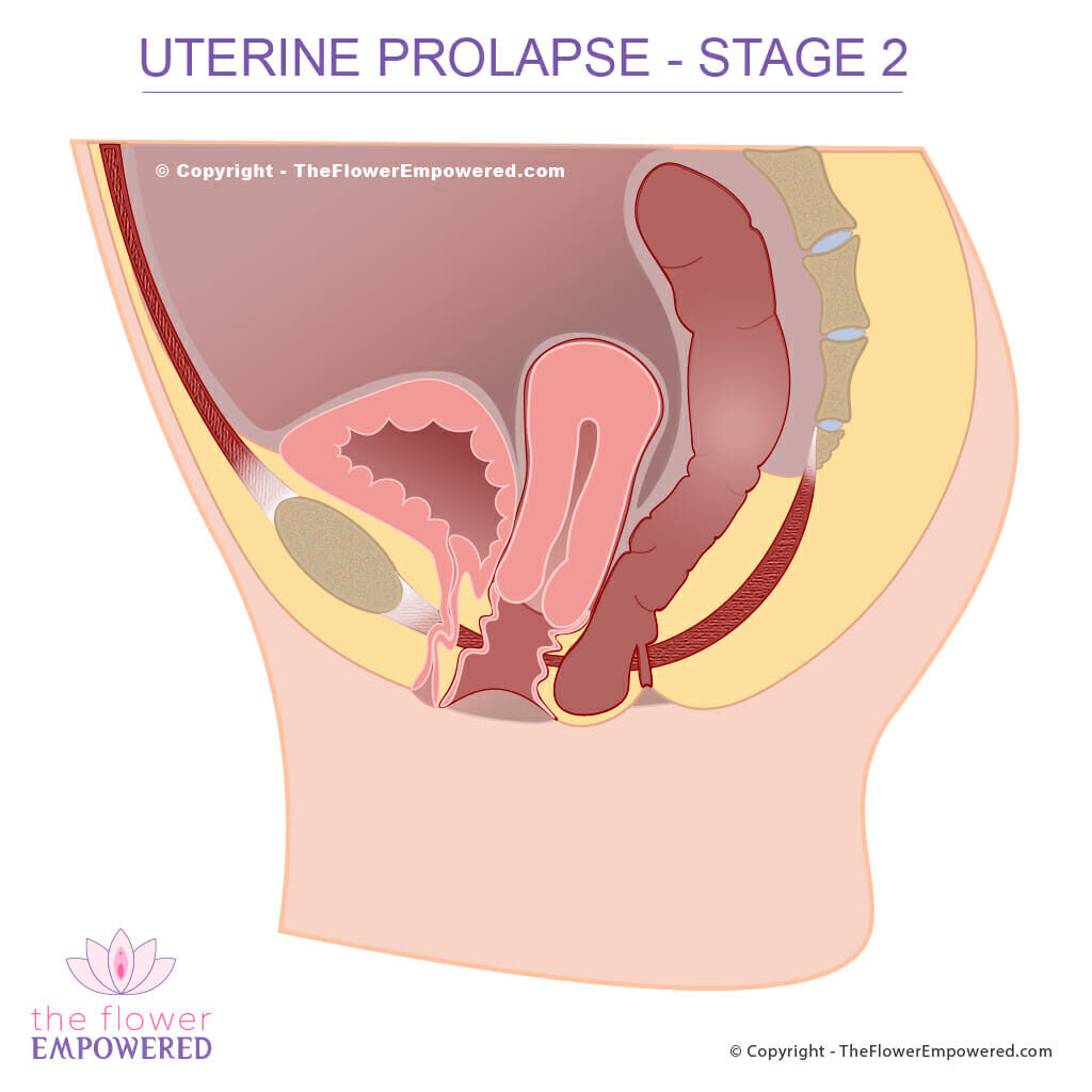 Uterine Pelvic Organ Prolapse stage 2