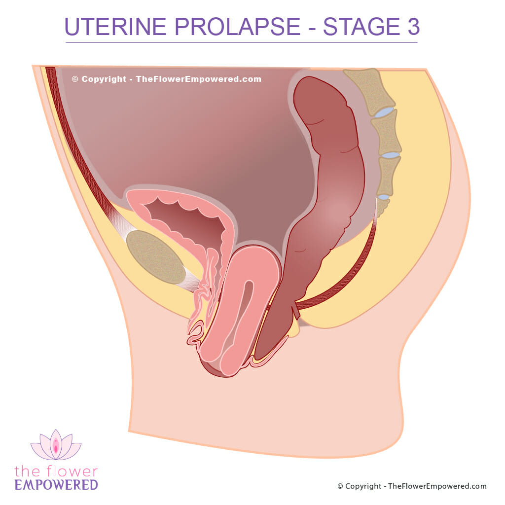women prolapsed uterus