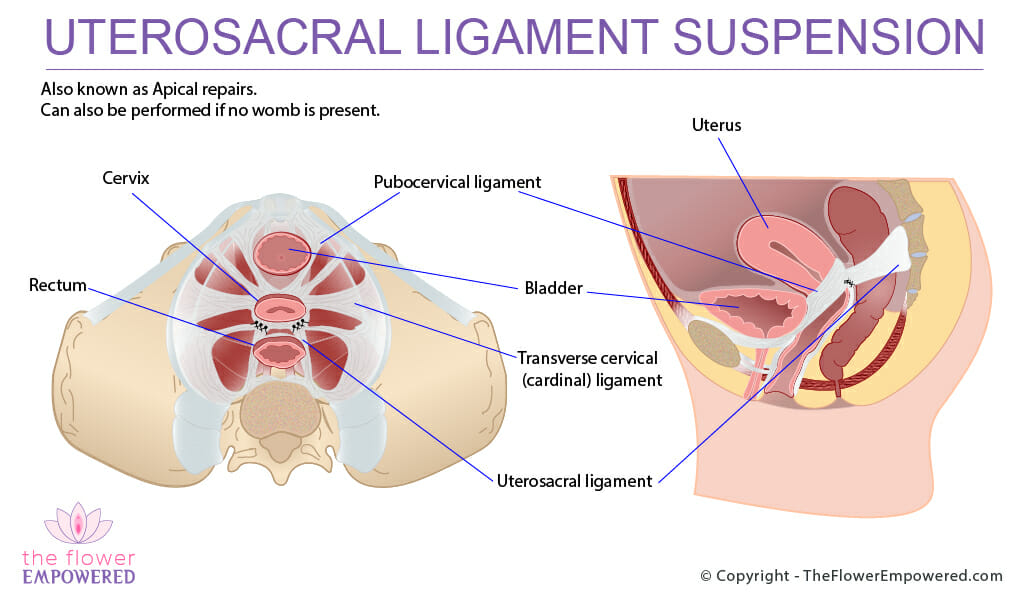 Uterosacral ligament suspension (apical repair)