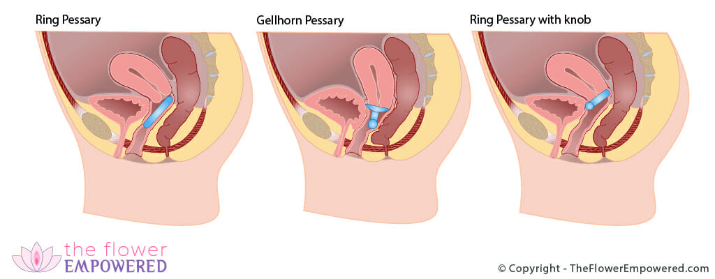 Vaginal Pessaries © Copyright - TheFlowerEmpowered.com