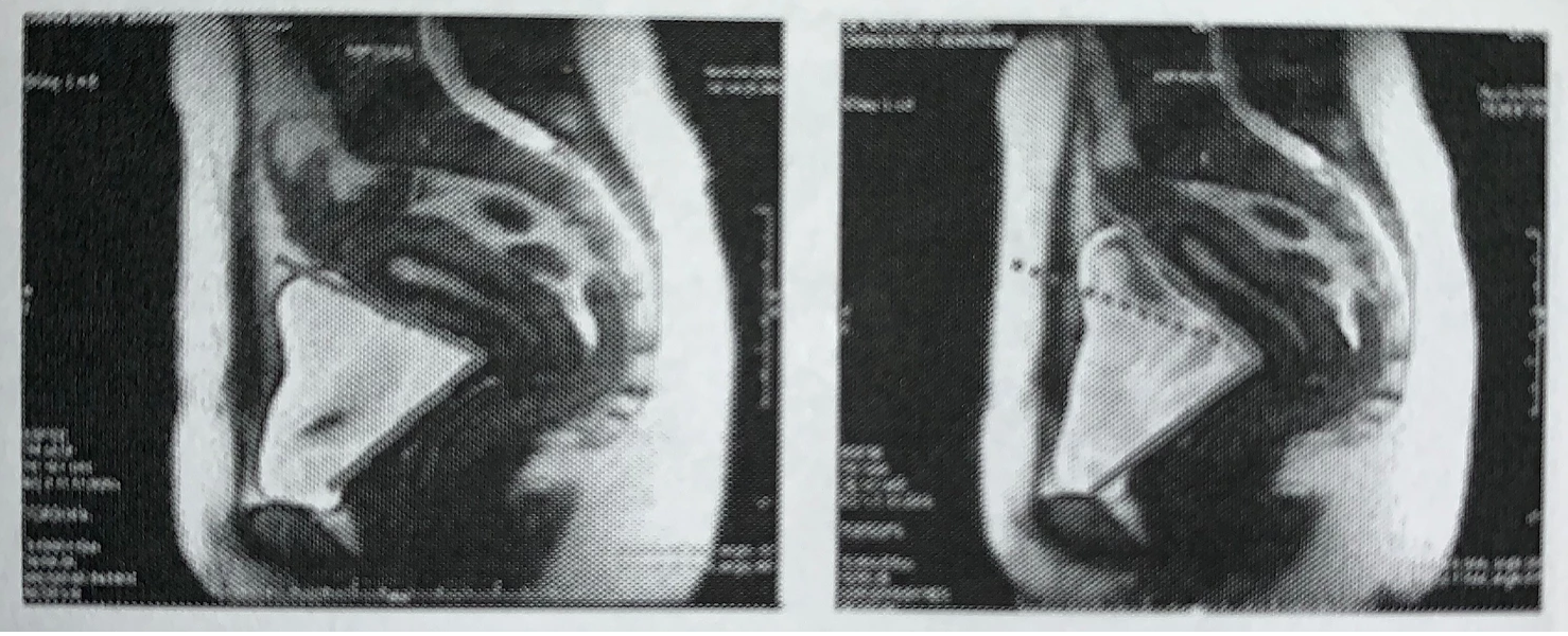 Pelvic Cavity Ultrasound