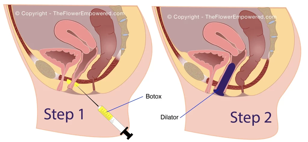 Surgical Treatments for Vaginismus - Botox